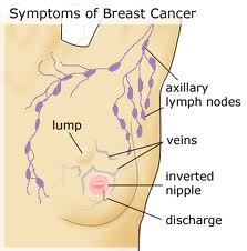 What You Should Know About Breast Cancer Symptoms