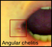 The Cause of Angular Chelitis