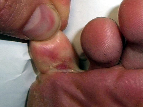 How to Get Rid of Athlete’s Foot and Corns Naturally