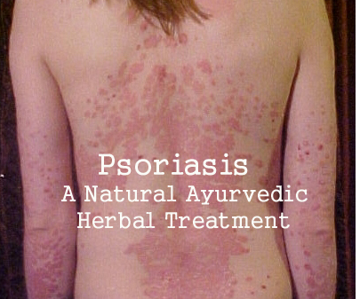 Psoriasis – A Natural Ayurvedic Herbal Treatment