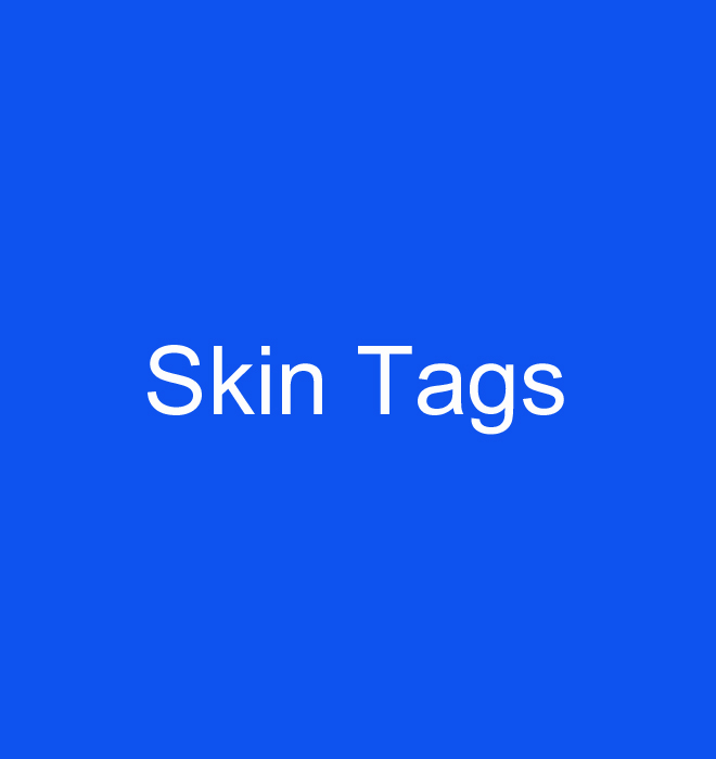 Top 5 Facts About Skin Tags