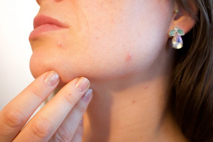 Tips for Preventing Acne at Any Age
