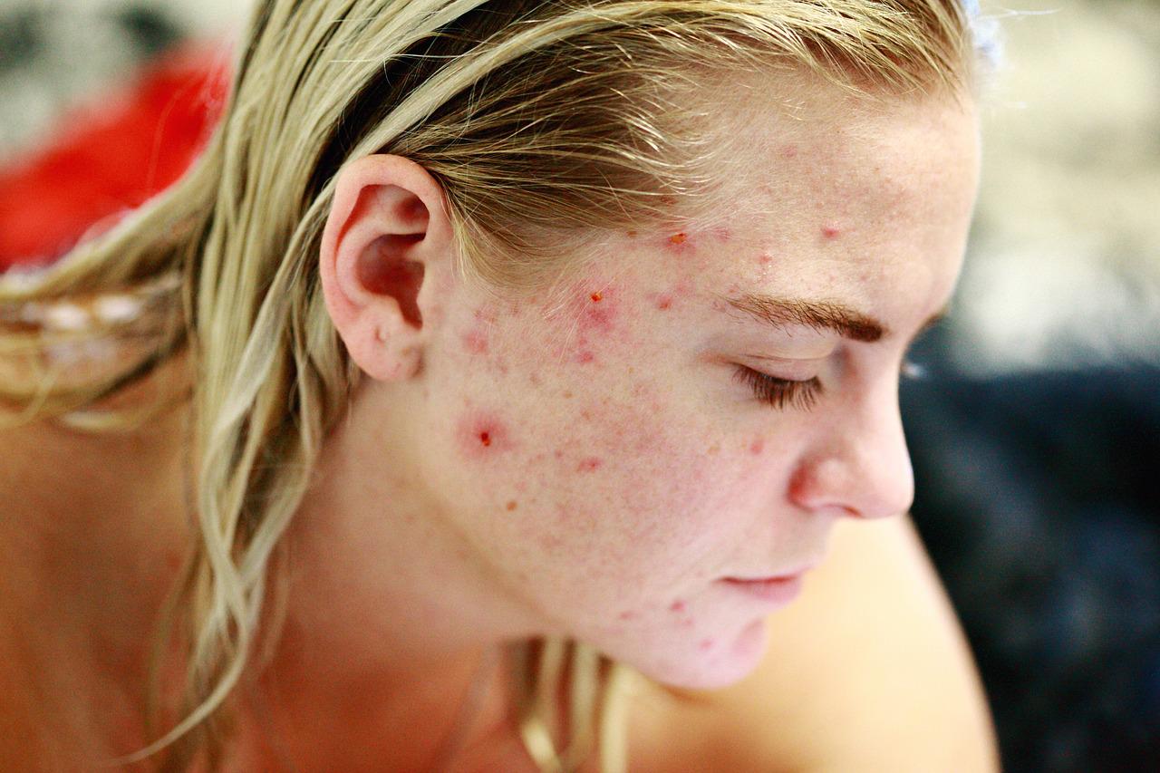 Acne - Herbal Treatment, Ayurvedic Remedies and Home Remedies
