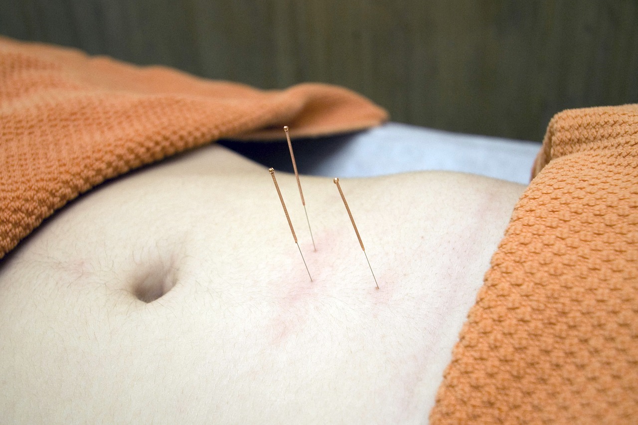 Getting Weight Loss Help from Acupuncture Treatments