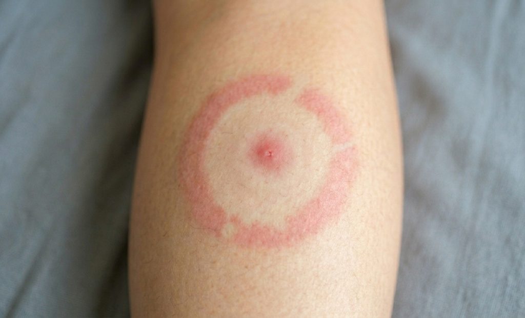 A close-up photograph shows a circular rash on human skin, resembling a target or bullseye, commonly associated with a tick bite and Lyme disease. The rash consists of a central red spot, surrounded by a clear skin area, and then an outer reddish ring with a slight gap. The skin has visible hair follicles and natural texture, set against a blurred gray fabric background.