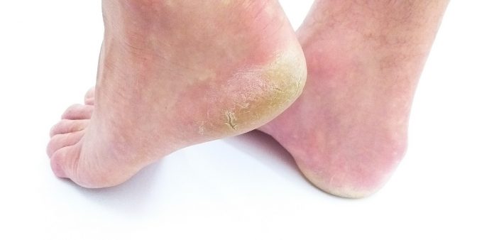 Effective Natural Cure for Cracked Heels