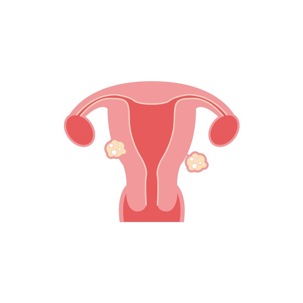 Relieve Uterine Fibroid Symptoms And Treatments Pioneer Thinking