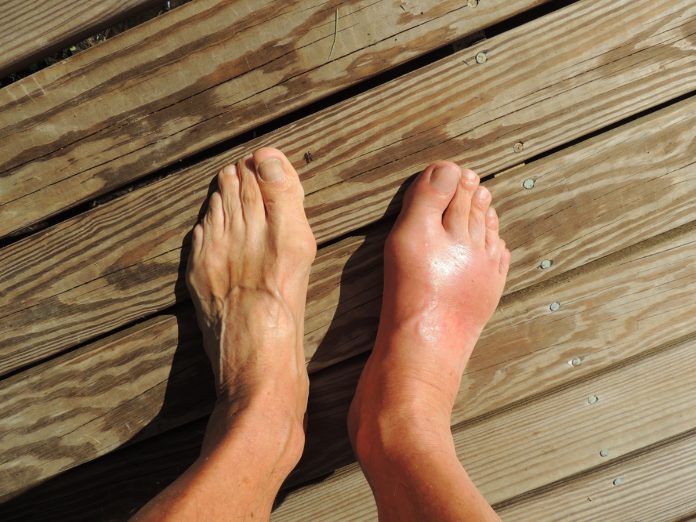 How to Cure Gout Naturally