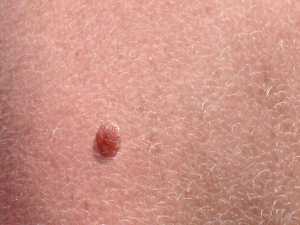 Effective Homemade Remedies for Skin Cancer